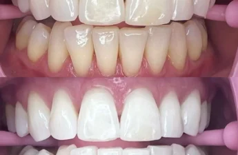 Can I Legally Learn Teeth Whitening as a Non-Dentist