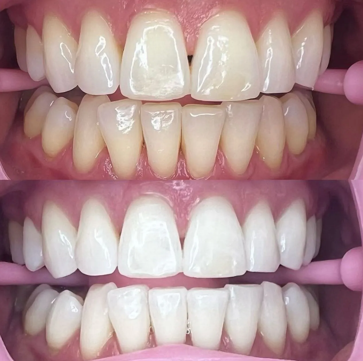 Can I Legally Learn Teeth Whitening as a Non-Dentist